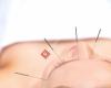 Acupunctuur Buqi Nollen